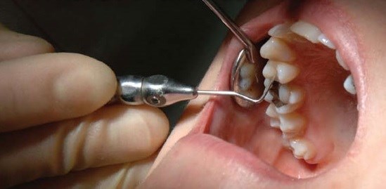 Holistic Dentistry NJ: Root Canal Alternative at HolisitcDentistryNJ.com